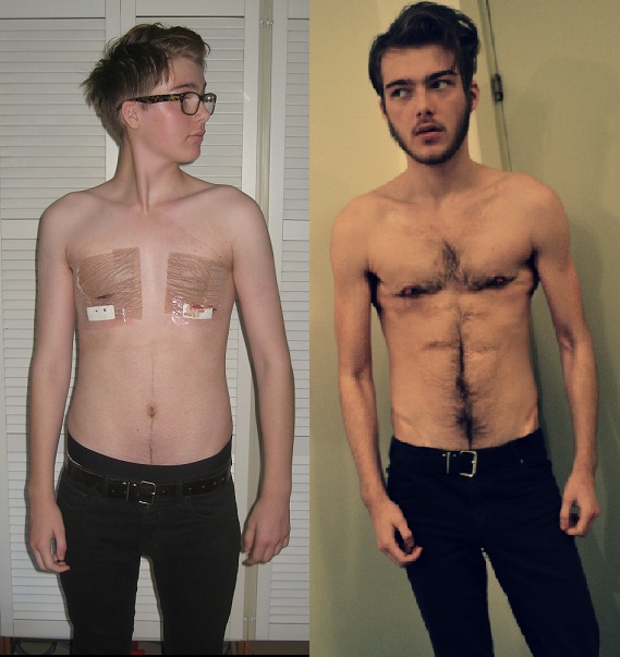 male transsexual surgury is rupert grint gay